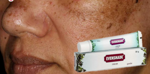 Ayurvedic Melasma Treatment Cream for skin pigmentation like melasma, chloasma